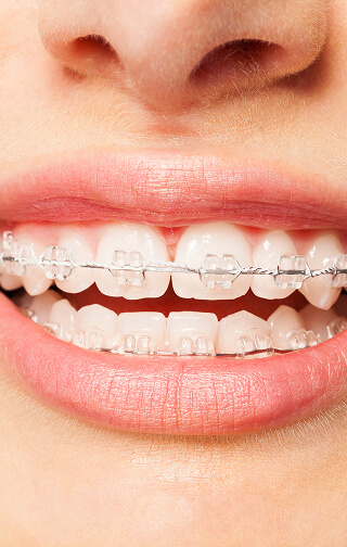 南舘歯科クリニック・矯正歯科のワイヤー矯正