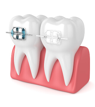 南舘歯科クリニック・矯正歯科の部分矯正