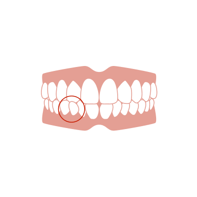 部分的に歯の位置がずれている